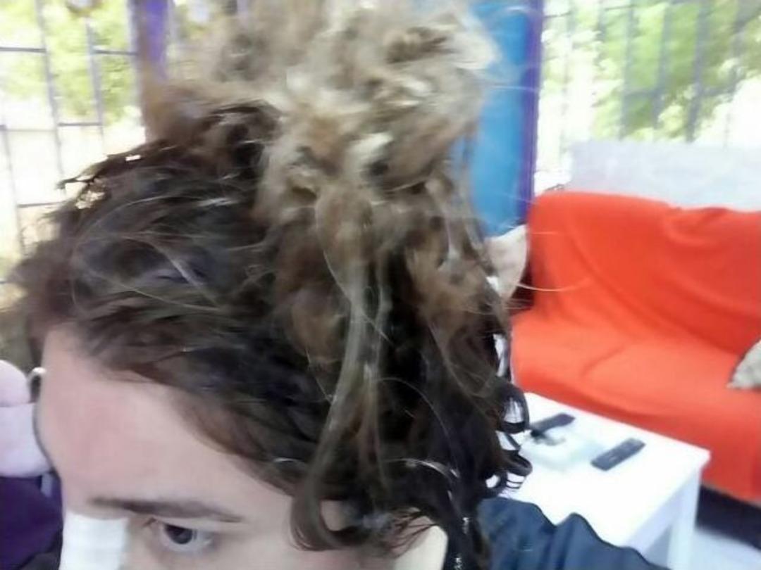 Yanlış Yıkama Ve Kimyasal Y&uuml;z&uuml;nden Sa&ccedil;ından Oldu İddiası