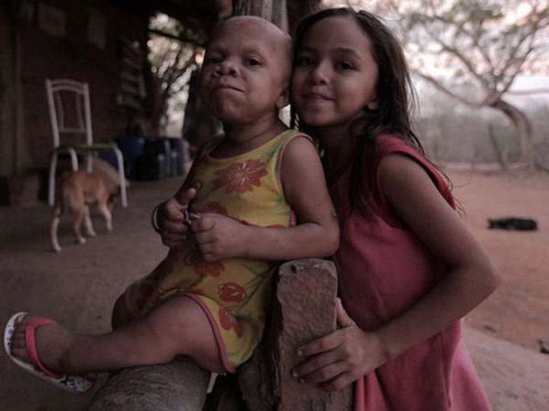 взрослая женщина в теле ребенка. взрослый и ребенок меняются местами. женщина с ребенком. мишель киш синдром халлермана. взрослая женщина в теле ребенка.