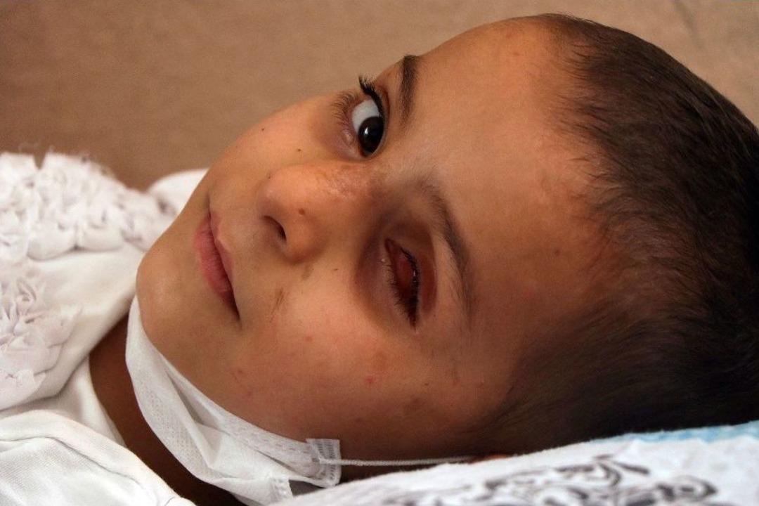 (&ouml;zel Haber) Esad G&uuml;&ccedil;lerinin Attığı Bombanın K&ouml;r Ettiği Minik Yasmin&rsquo;in Yardım &Ccedil;ığlığı