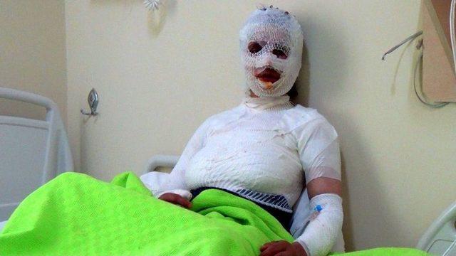 &Uuml;zerine Kaynar Su D&ouml;k&uuml;len 8 &Ccedil;ocuk Annesi Kadın Yandı 1