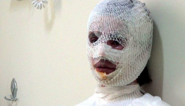 &Uuml;zerine Kaynar Su D&ouml;k&uuml;len 8 &Ccedil;ocuk Annesi Kadın Yandı 2