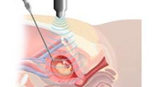 Amniosentez Nedir, Neden Yapılır?