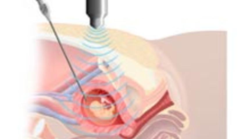 Amniosentez Nedir, Neden Yapılır?