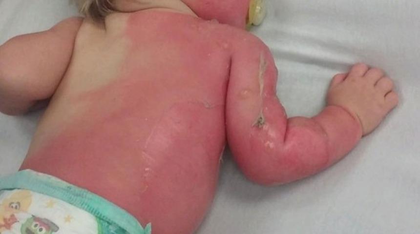 &Ccedil;ocuk havuza girince b&uuml;t&uuml;n v&uuml;cudu yandı! Ailesi herkesi uyarıyor