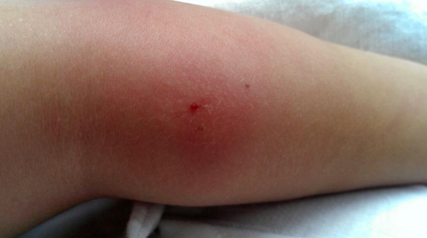 &Ccedil;ocuklarda b&ouml;cek sokmasını dikkate alın 