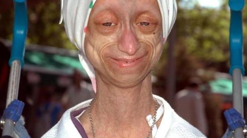 Fanatik Fenerbah&ccedil;eli Erken Yaşlılık Hastası Gamze&rsquo;Nin &Ouml;l&uuml;m&uuml; Kayseri&rsquo;De &Uuml;z&uuml;nt&uuml; Yarattı