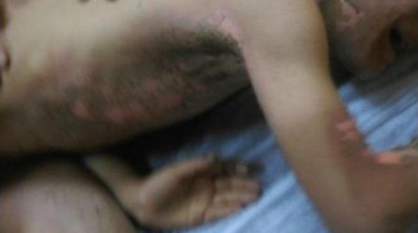 Onarılmayan Elektrik Direği 8 Yaşındaki &Ccedil;ocuğu Ağır Yaraladı