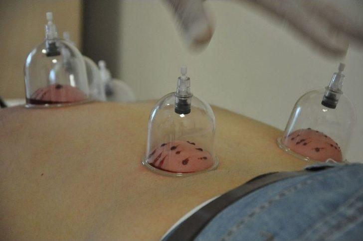 Devlet Hastanesinde Hacamat Ve Akupunktur Polikliniği Açıldı G5