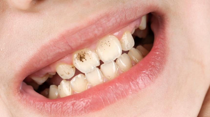 Çocuklarda diş çürükleri artık sorun değil