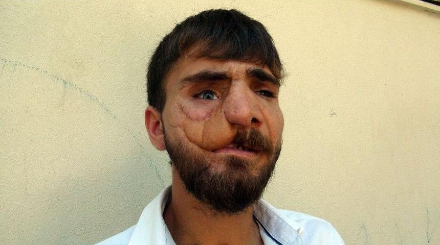 25 Yaşında 38 Ameliyat Ge&ccedil;irdi