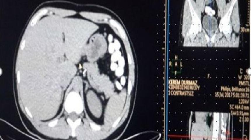 Faslı Uyuşturucu Kuryesinin Midesinden 78 Adet Kaps&uuml;l Uyuşturucu &Ccedil;ıktı