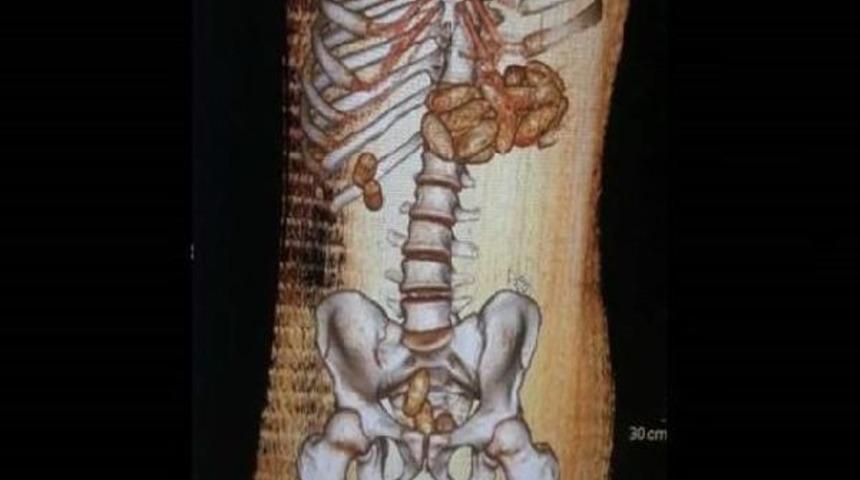55 Kaps&uuml;le Dolduldurulmış 1 Kilogram Kokain Yuttu