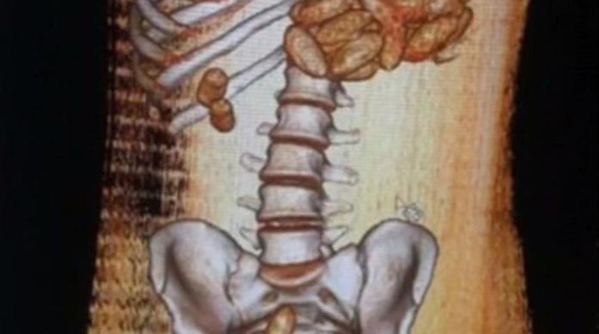 Nijeryalı Kuryenin Midesinden 1 Kilo 80 Gram Kokain &Ccedil;ıktı