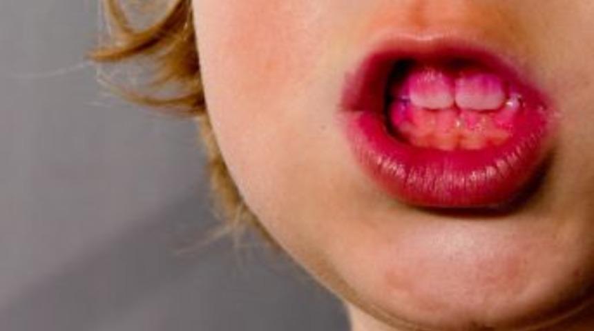 Balıbey &lsquo;diş Lekelerinde &Ccedil;&ouml;z&uuml;m Kişiye &Ouml;zel Olmalı&rsquo;