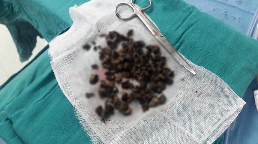 B&ouml;breğinden &Ccedil;ıkan 50 Par&ccedil;a Taş Doktorları Bile Şaşırttı