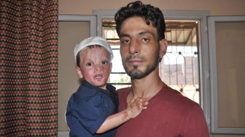 Suriyeli Baba, Yanan Oğlu Bara'ya Estetik Ameliyat Istiyor