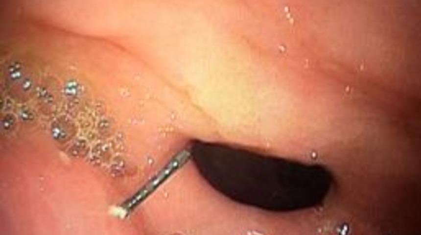 Petek Bal Yedi, Midesinden 10 Santim Tel &Ccedil;ıktı