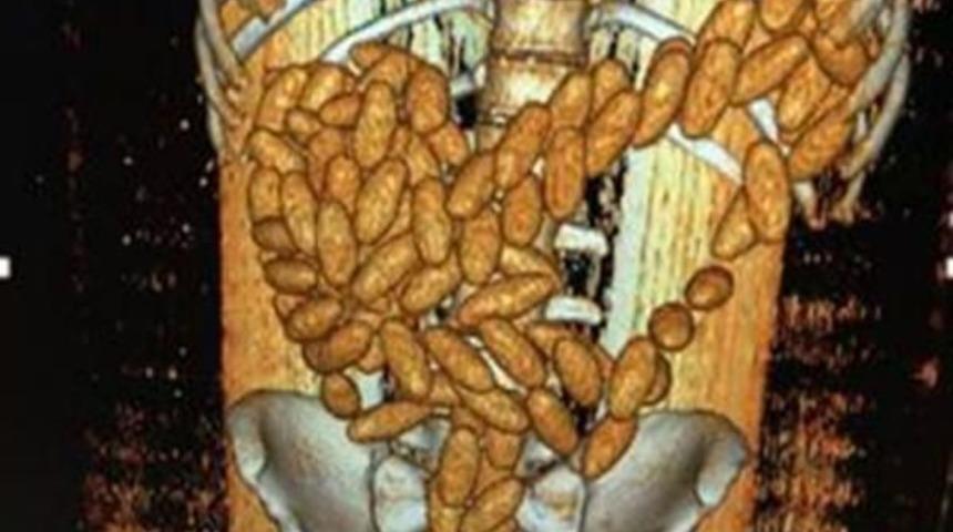 Valizi Ve Midesinde 111 Prezervatif I&ccedil;inde 480 Gram Esrar Bulundu