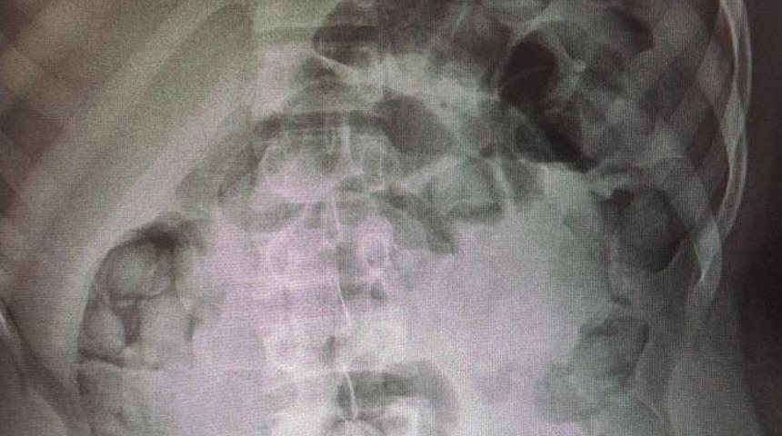 İranlı Kuryenin Midesinden Eroin &Ccedil;ıktı