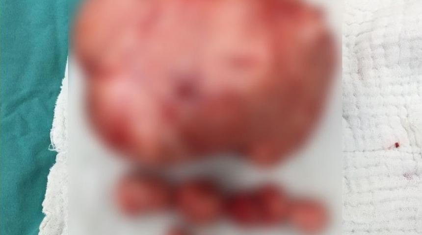 Ameliyat Olan Kadının Rahminden 4 Kiloluk Kitle &Ccedil;ıktı