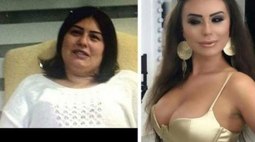 G&uuml;zellik Uğruna 17 Kez Bı&ccedil;ak Altına Yatıp 100 Bin Lira Harcadı