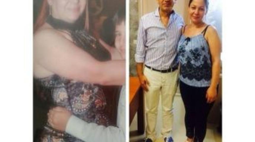 T&uuml;p Mide Ameliyatıyla 6 Ayda 123 Kilodan 83 Kiloya D&uuml;şt&uuml;