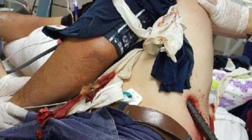 İnşaat Iş&ccedil;isinin V&uuml;cuduna Saplanan Demir &Ccedil;ıkarıldı