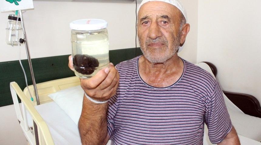Kasık Ağrısı Şikayeti İle Gitti, Mesanesinden Tek Par&ccedil;a Halinde 120 Gram Taş &Ccedil;ıktı