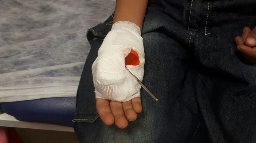 Eline Saplanan Şişle Hastaneye Getirildi