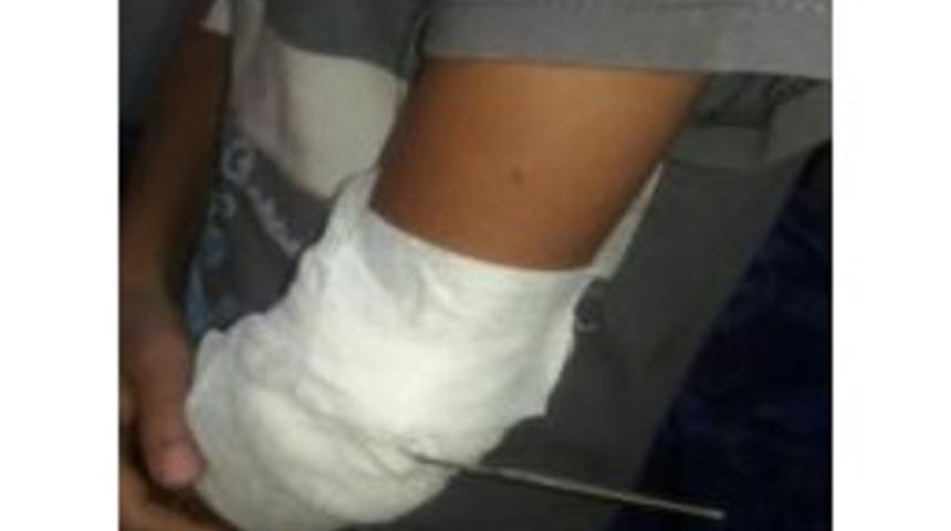 Oyun Oynarken Koluna Tığ Battı