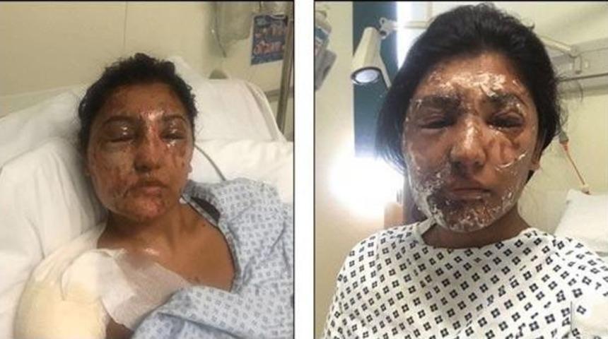 Asit Saldırısı Kurbanı Normal Bir Hayat Yaşayacak