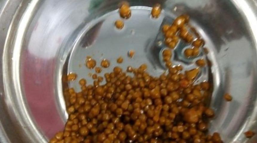 Safra Kesesinden 710 Taş &Ccedil;ıktı