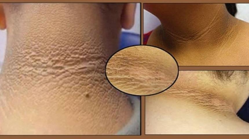 Boynunuzda B&ouml;yle Bir Şey Fark Ederseniz Mutlaka Doktora Gidin!