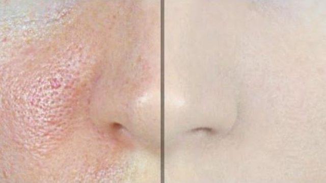 Pahalı Kremleri Unutun: İri Gözeneklerden Kurtuluyoruz 1