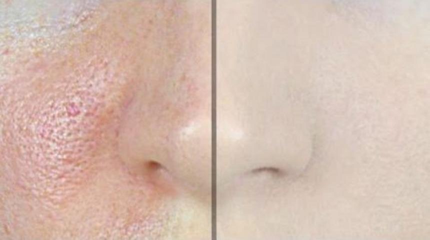 Pahalı Kremleri Unutun: İri G&ouml;zeneklerden Kurtuluyoruz