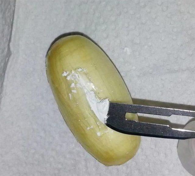 Brezilyalı Kadının Midesinde 59 Kaps&uuml;l Kokain 2