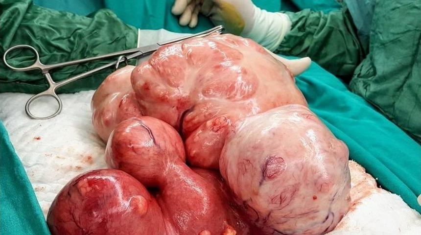 36 Yaşındaki Kadının Karnından 5 Kilogram Ur &Ccedil;ıkarıldı