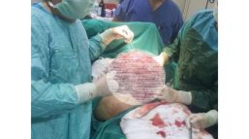 Karnından 11 Kilogram Ağırlığında Bir Kitle &Ccedil;ıkartıldı