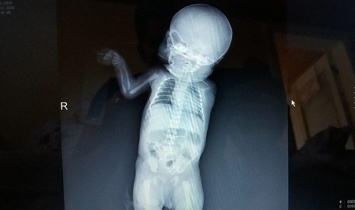 ’sağlıklı’ Dediler, Kolsuz Doğdu G5