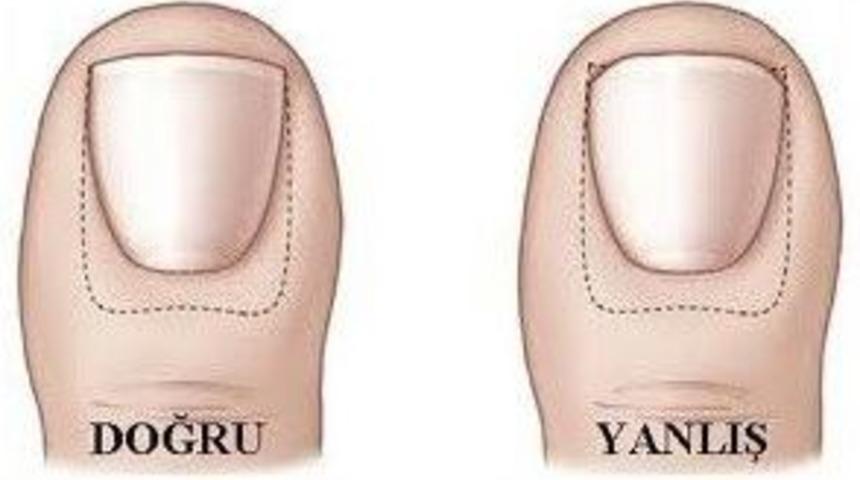Tırnak Batmasında Uygulanan Yanlış Y&ouml;ntemlere Dikkat