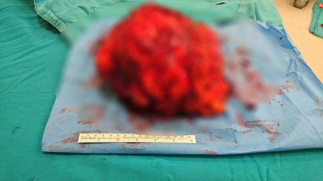 D&uuml;nyada İkinci Kez Rastlanan Vaka Doktorları Bile Şaşırttı