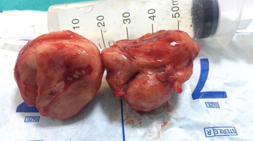 Ameliyatla 200 Gramlık Prostatı Aldılar