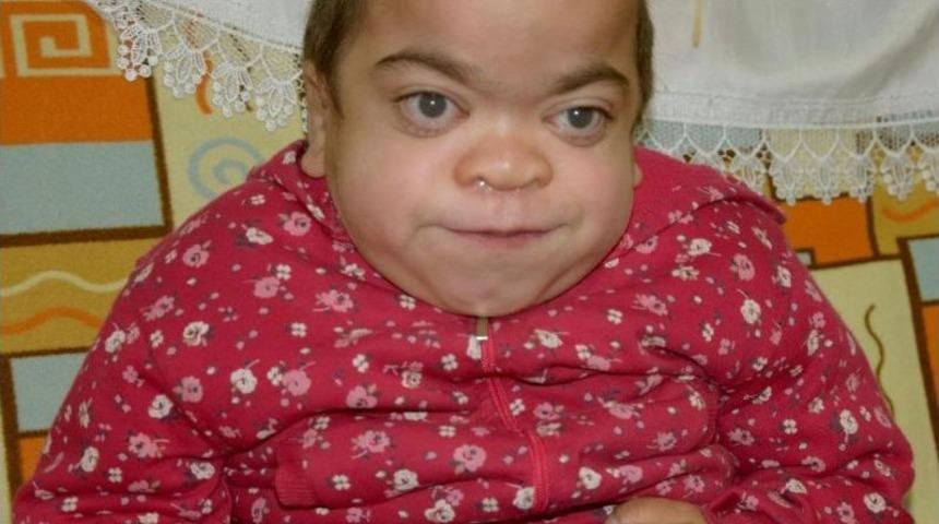 Mps Hastası Küçük Kız Hayatını Kaybetti