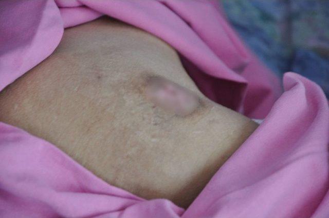 (özel Haber) Ameliyatla Kapanmaz Denilen Yaraları Evde Tedaviyle Kapandı 1