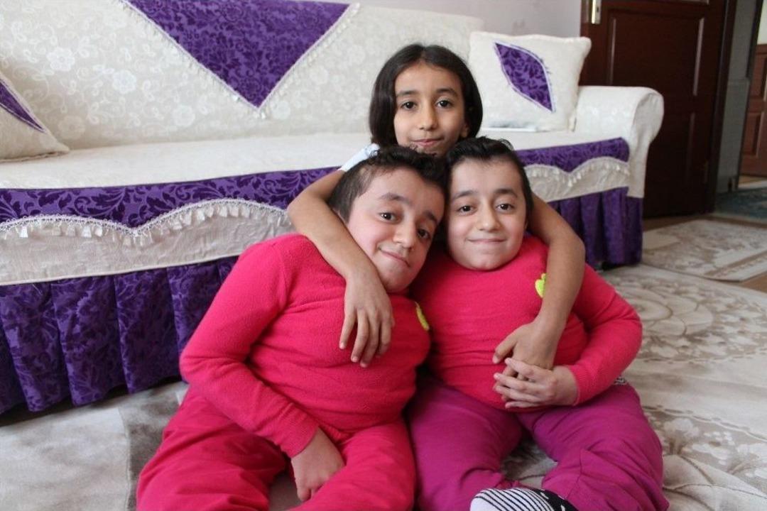 Cam Kemik Hastası İkizlerden Birinin Kemiği Kırılınca Diğeri De Hissediyor