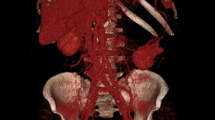Sessiz Gelen Tehlike: "b&ouml;brek Kanseri"