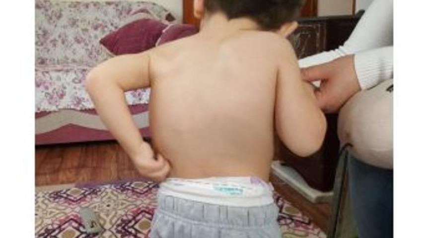 18 Kez Kalbi Duran 3 Yaşındaki Berkay Yardım Bekliyor