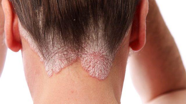 Sedef hastalığının belirtisi ve tedavisi 