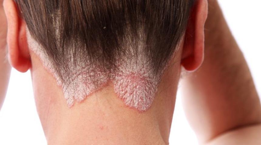 Sedef hastalığının belirtisi ve tedavisi 