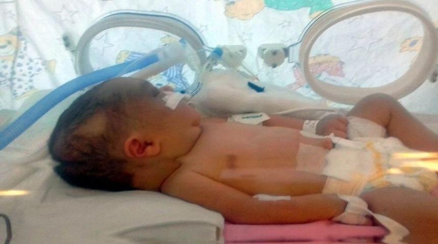 Kafatası &Ccedil;atlayan 6 G&uuml;nl&uuml;k Bebek, Yaşam Savaşı Veriyor